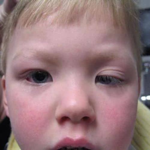 กล้ามเนื้ออ่อนแรง แต่กำเนิด